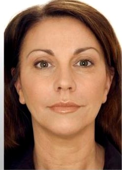 Mieke HIFU Face Lifting result โ after
