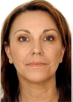 Mieke HIFU Face Lifting result โ before