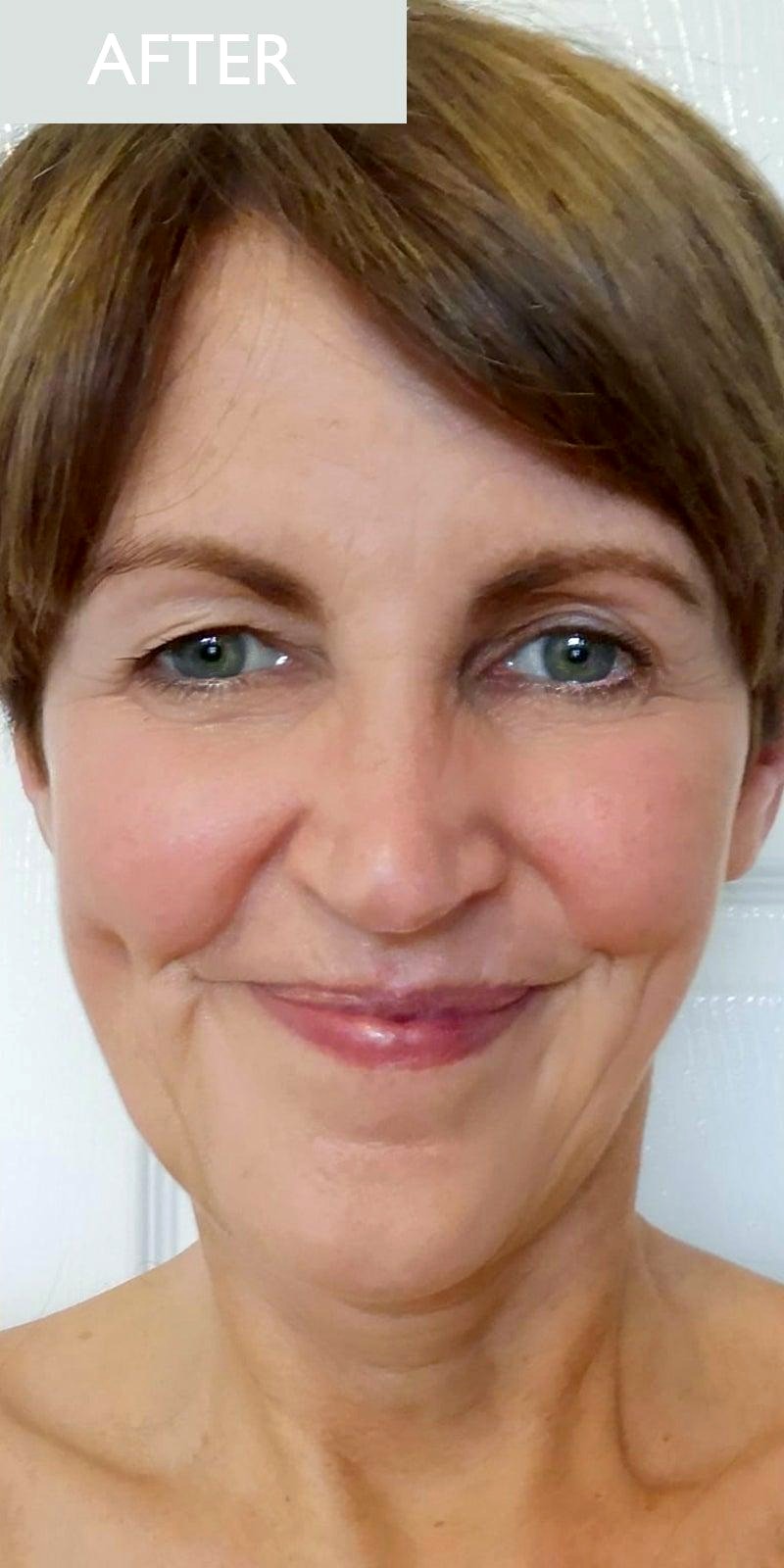 Anri V. RF Skin Tightening result โ after