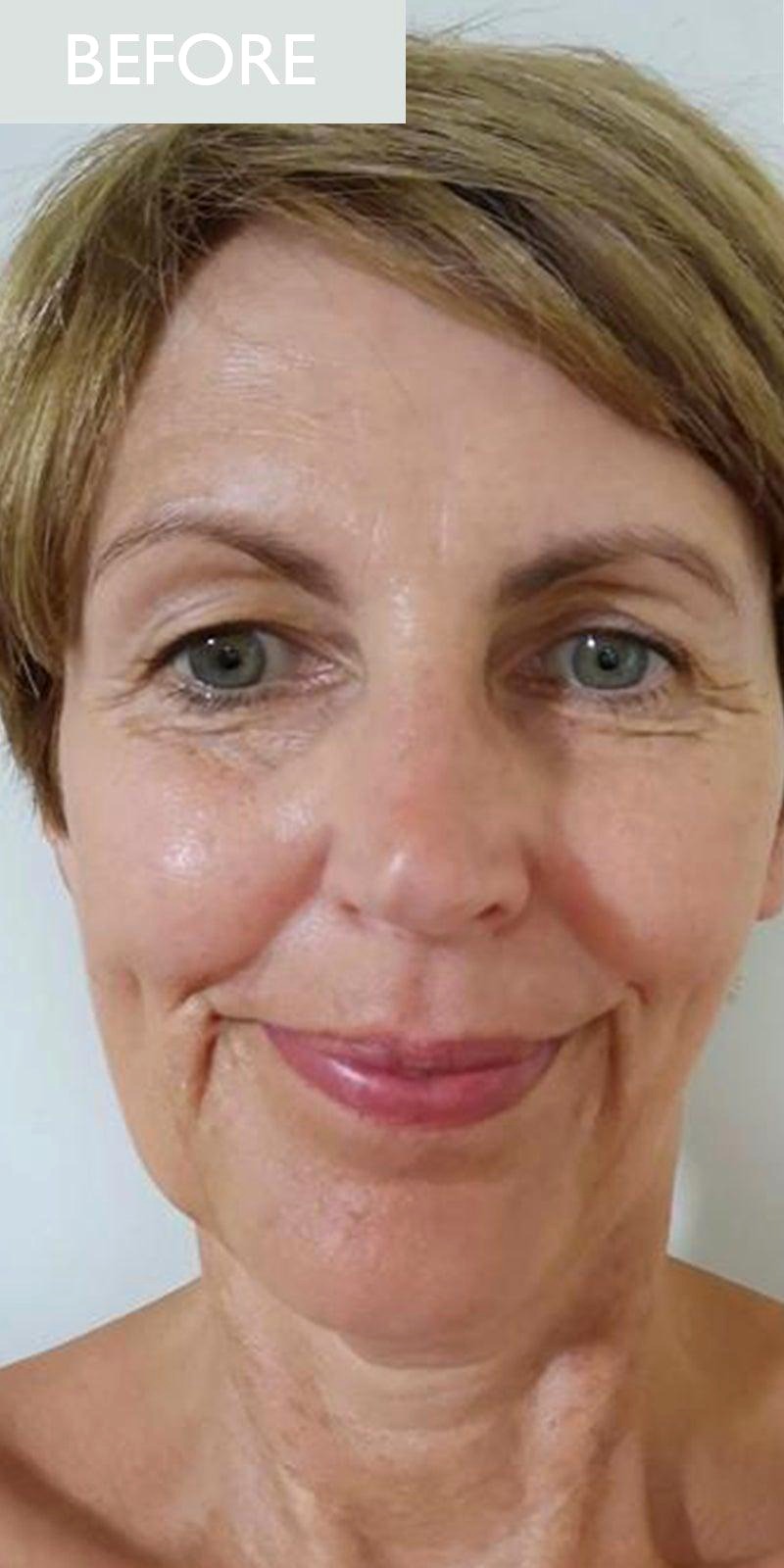 Anri V. RF Skin Tightening result โ before