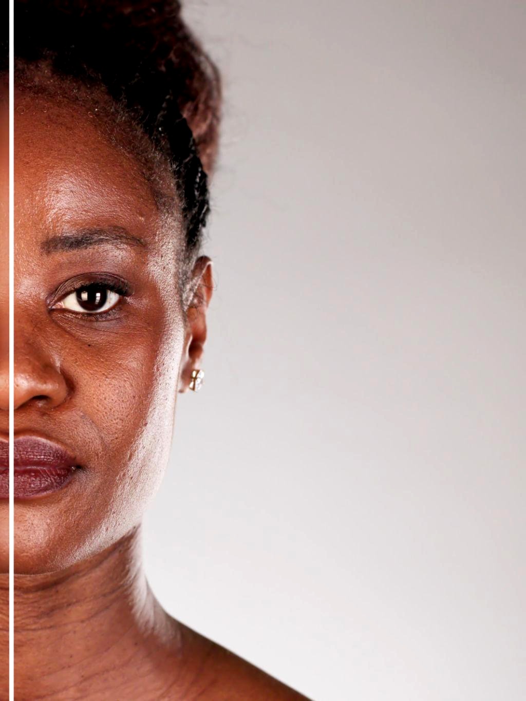 Nompumelelo D. LED Skin Rejuvenation result โ before