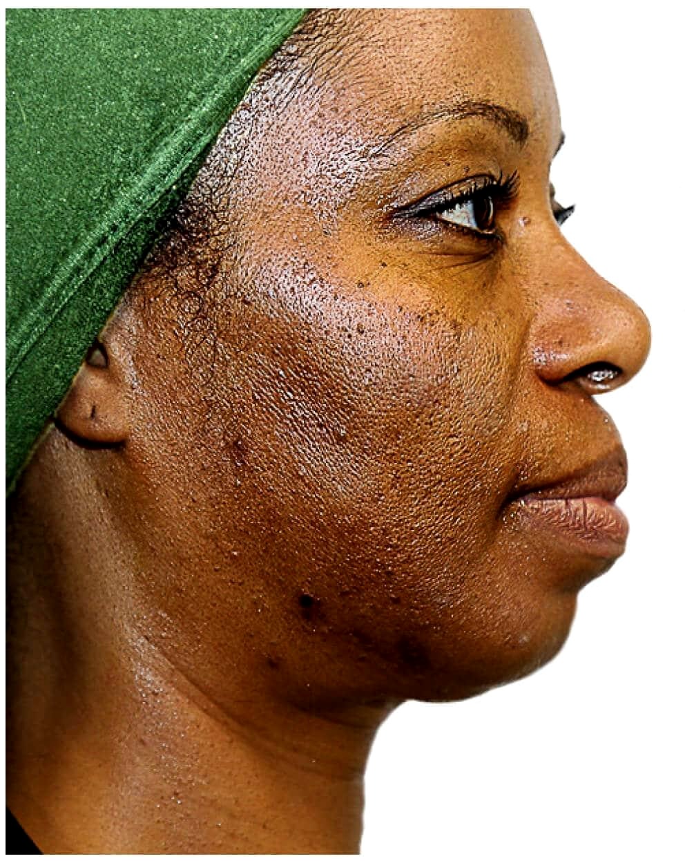 Zanele P. RF Skin Tightening result โ before