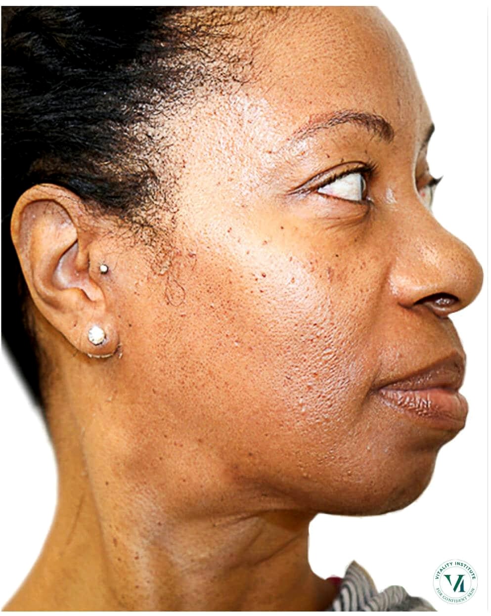 Zanele P. RF Skin Tightening result โ after